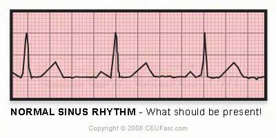 ekg normal sinus rhythm