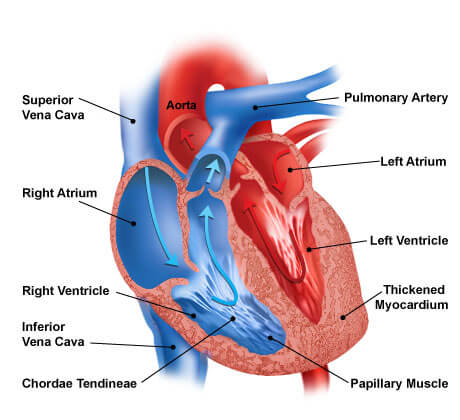heart failure cut-away