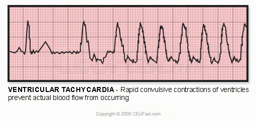 EKG ventricular tachycardia