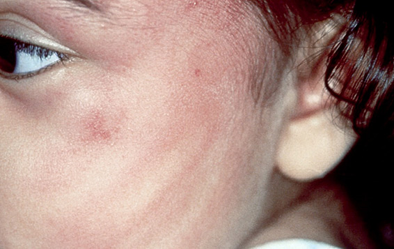 photo of handprint injury on childs face