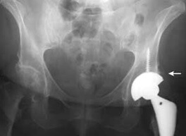 Hip replacement
