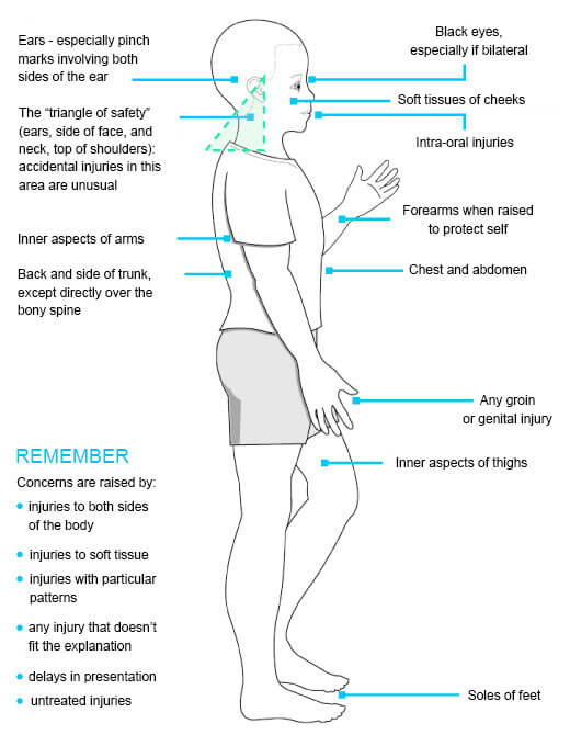 graphic showing physical indicators of abuse