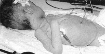 photo of child with neglect