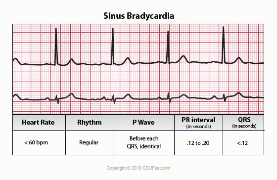 sinus bradycardia