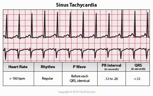sinus tachycardia