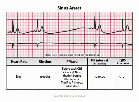 sinus arrest