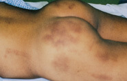 photo of bruising on torso, buttocks and thighs