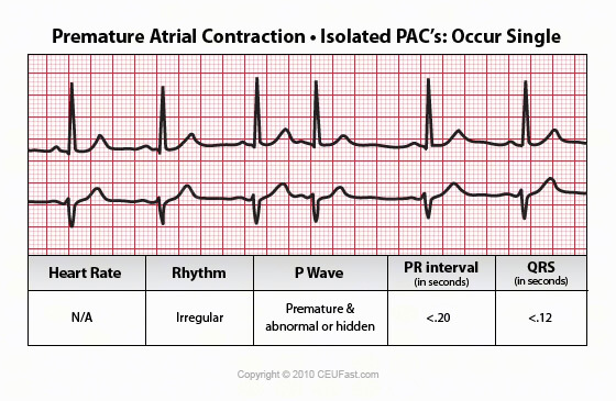 premature atrial contraction