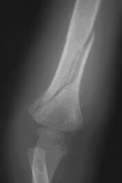 photo of spiral fracture x-ray