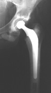 Hip replacement