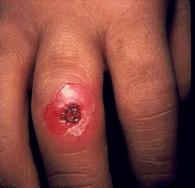photo of cigarette burn on child finger
