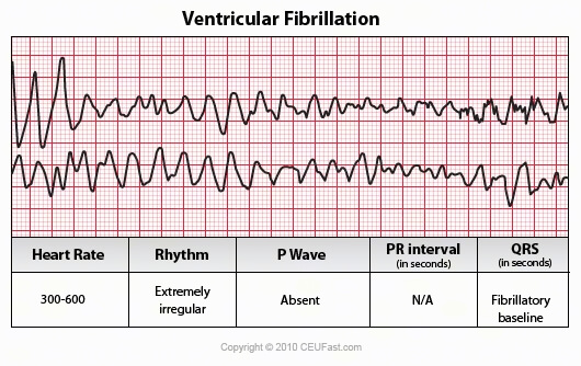 ventricular fibrillation