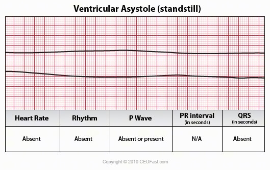 image of ventricular asystole