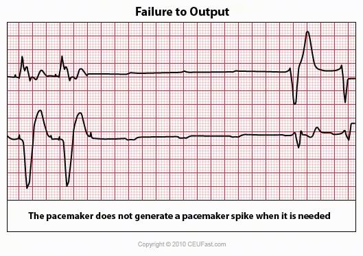 failure to output ekg