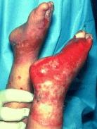 photo of sock like burn of the feet