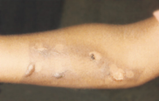 steam iron burn on arm