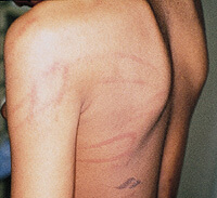 photo of looped cord injury on back