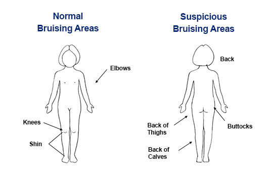 graphic showing bruising areas