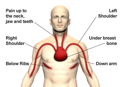 Graphic showing cardiac pain map