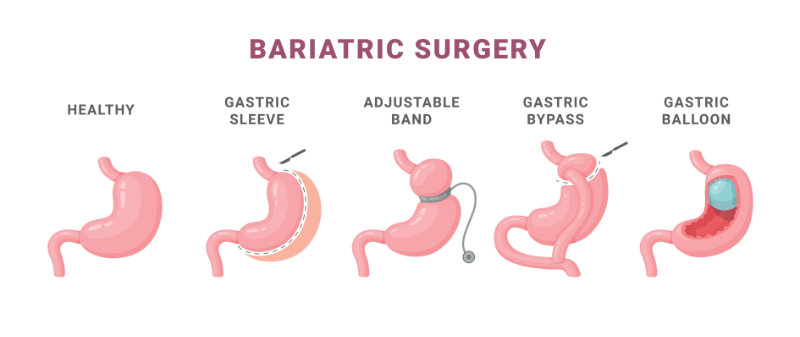 graphic showing bariatric surgery