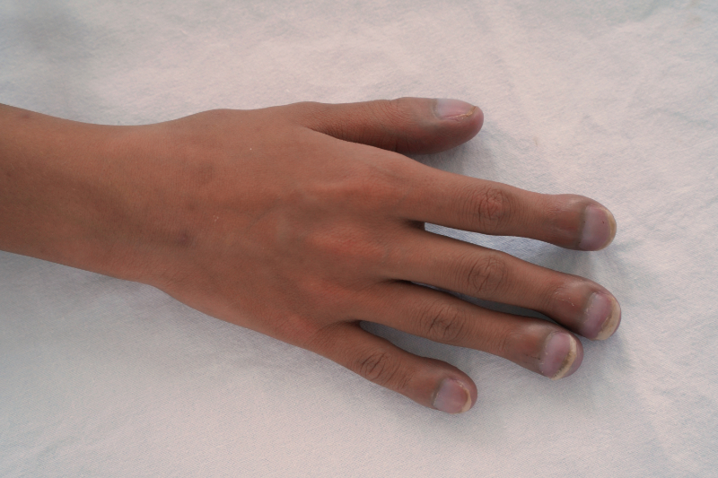 photo of patient who has blunted fingers