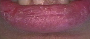 Cracked, Red Lips Seen in Kawasaki Disease