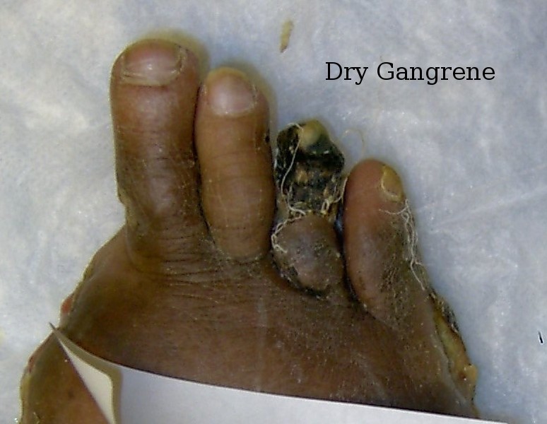 photo of dry gangrene on toe