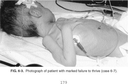photo of child with failure to thrive