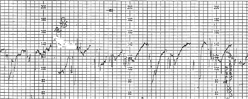 graphic showing prolonged atypical variable deceleration of fetal heart rate