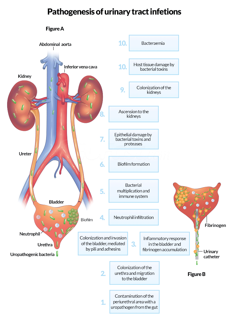 Figure 3 A and B Pathogenesis of UTIs