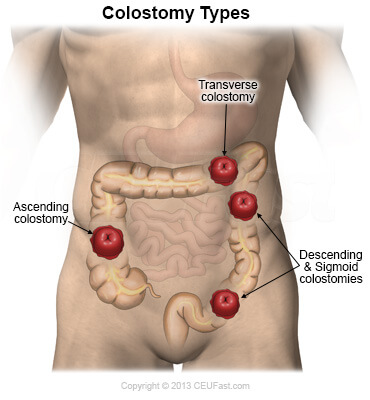 graphic showing colostomy stoma types and locations
