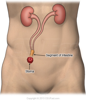 graphic showing ileal conduit stoma creation