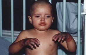 photo of child with glove burns on hands