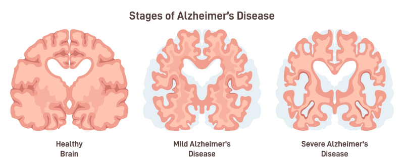 graphic showing health vs alzheimers brain