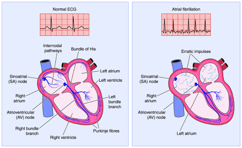 image of atrial fibrillation graphic