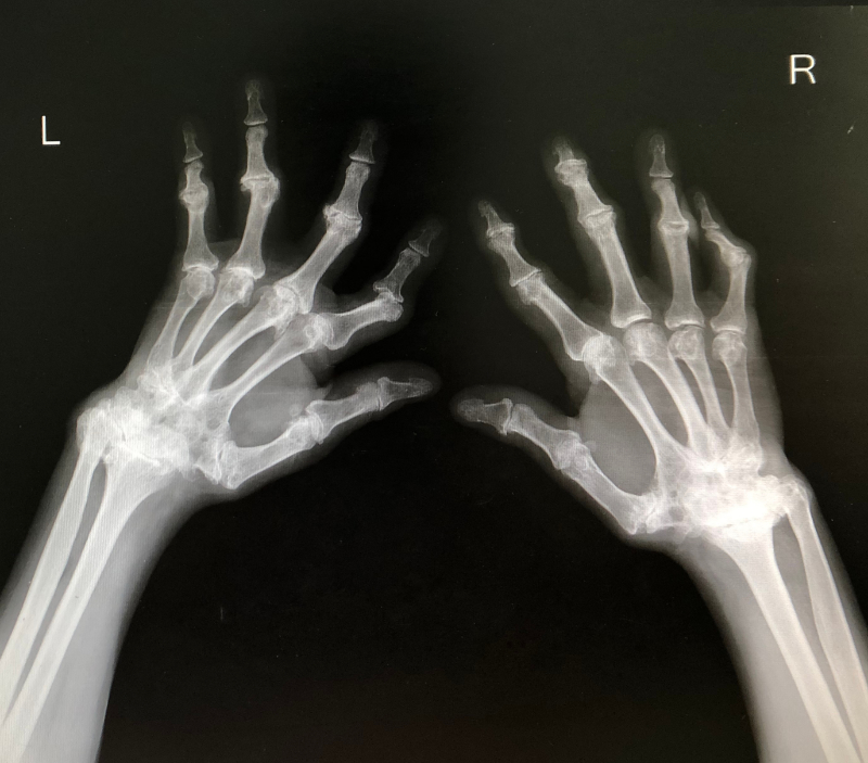 xray of patients hands with rheumatoid arthritis