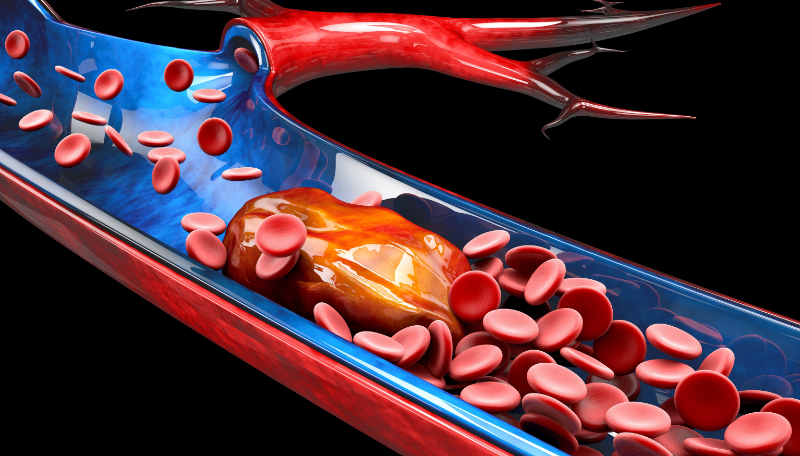 graphic showing blood clot