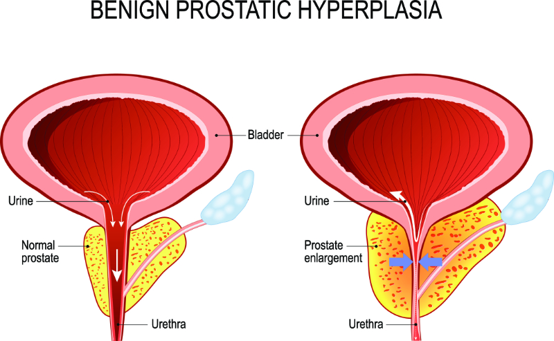 Graphic showing Benign Prostatic Hyperplasia