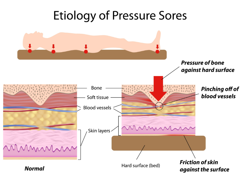 graphic showing the breakdown of etiology of pressure sores