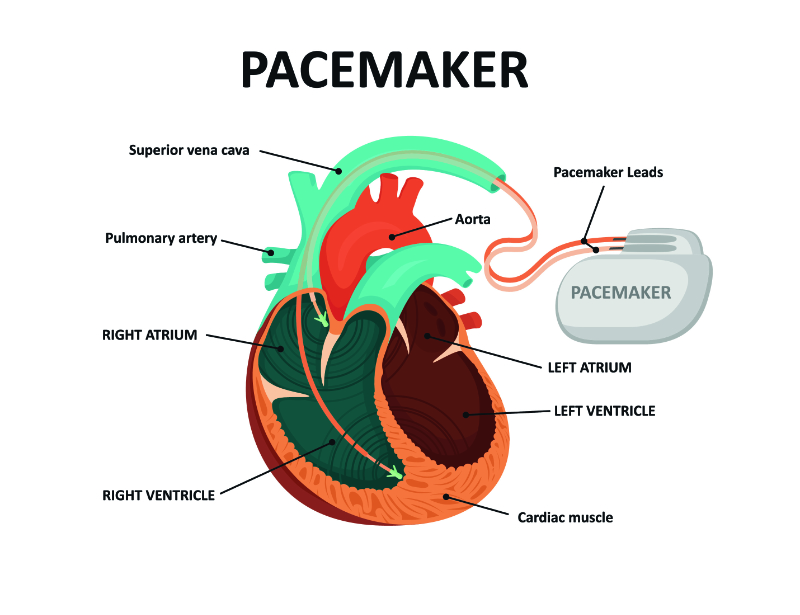 pacemaker and heart graphic