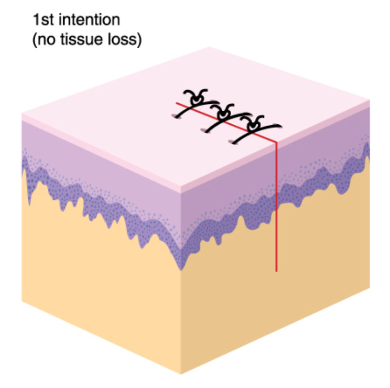 graphic showing primary intention example