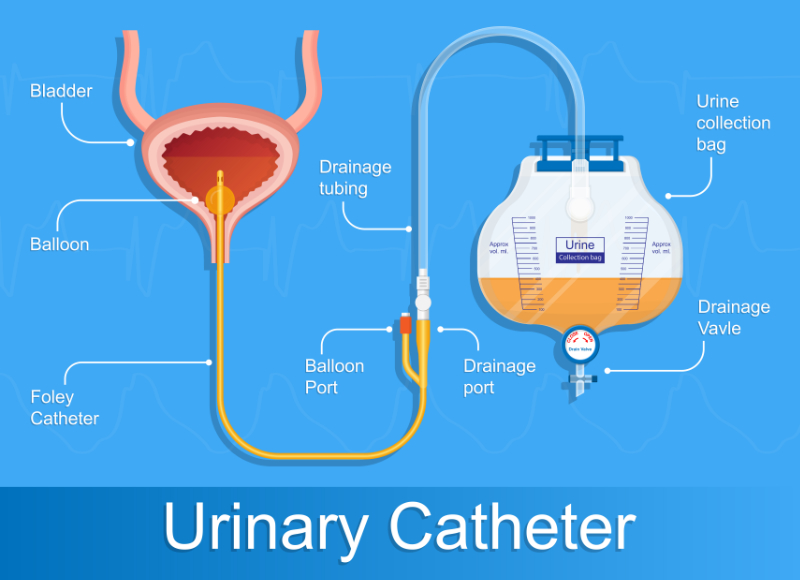 graphic showing urinary catheter