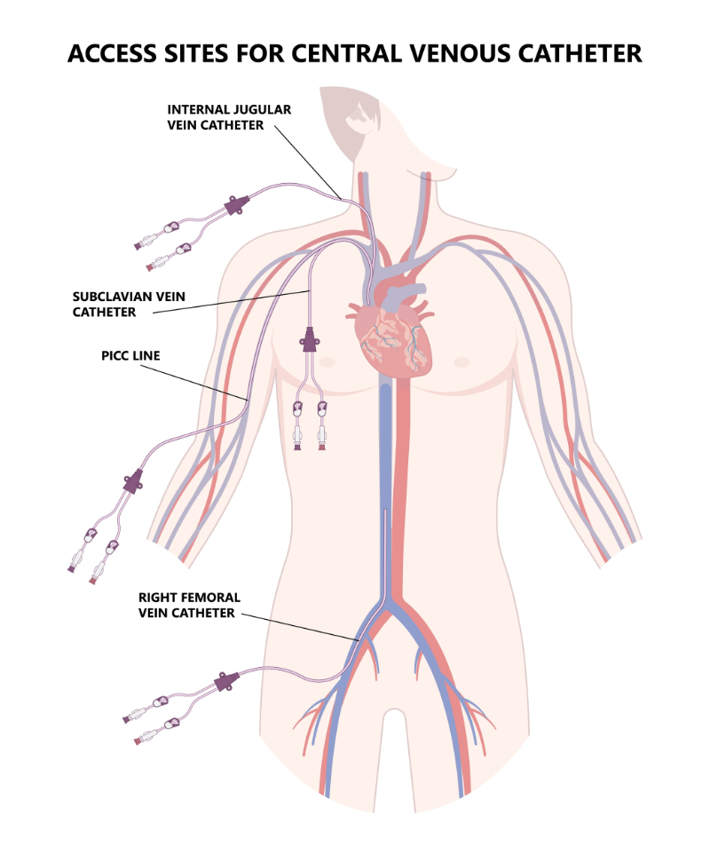 graphic of picc line access sites