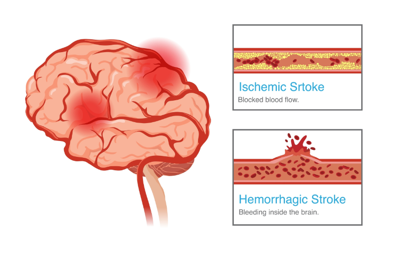 graphic showing types of stroke activity