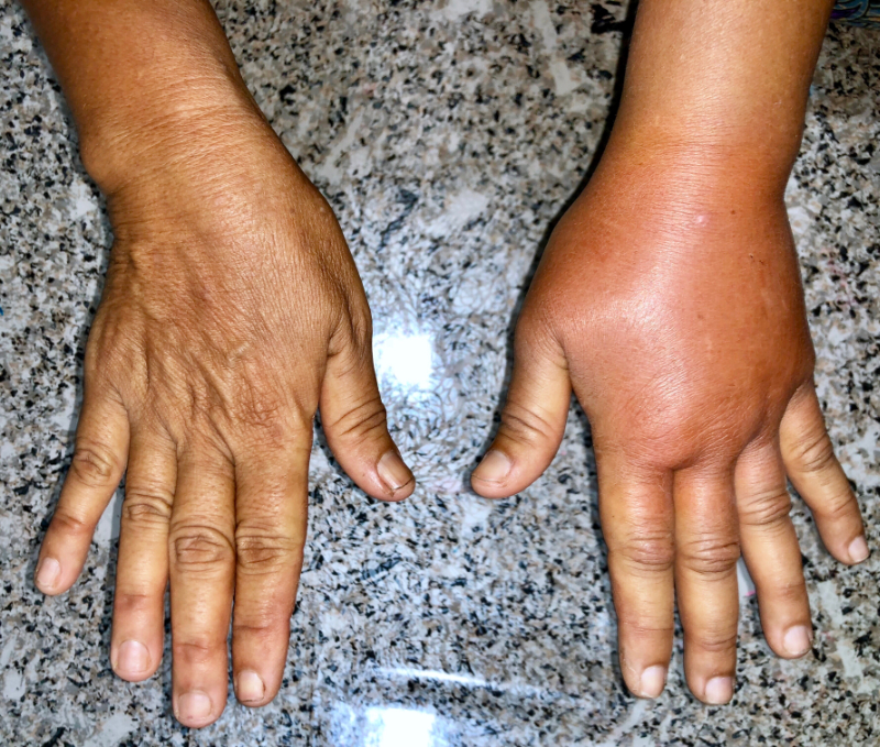 photo of unilateral lymphedema