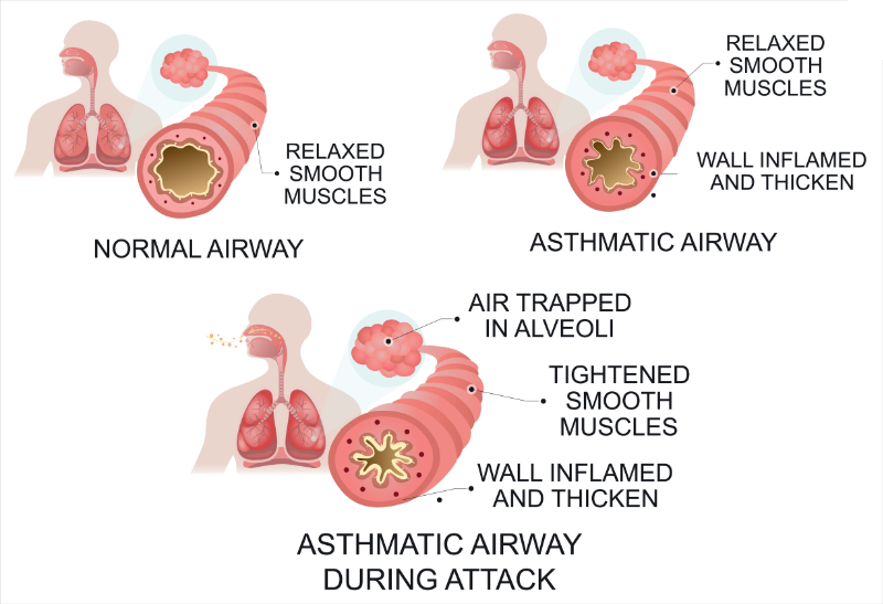 graphic showing labeled asthma attach in airway