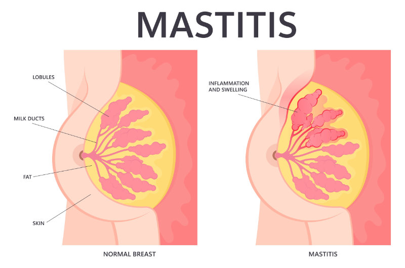 graphic showing mastitis