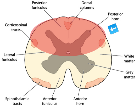 graphic showing location of lesion in dorsal cord syndrome