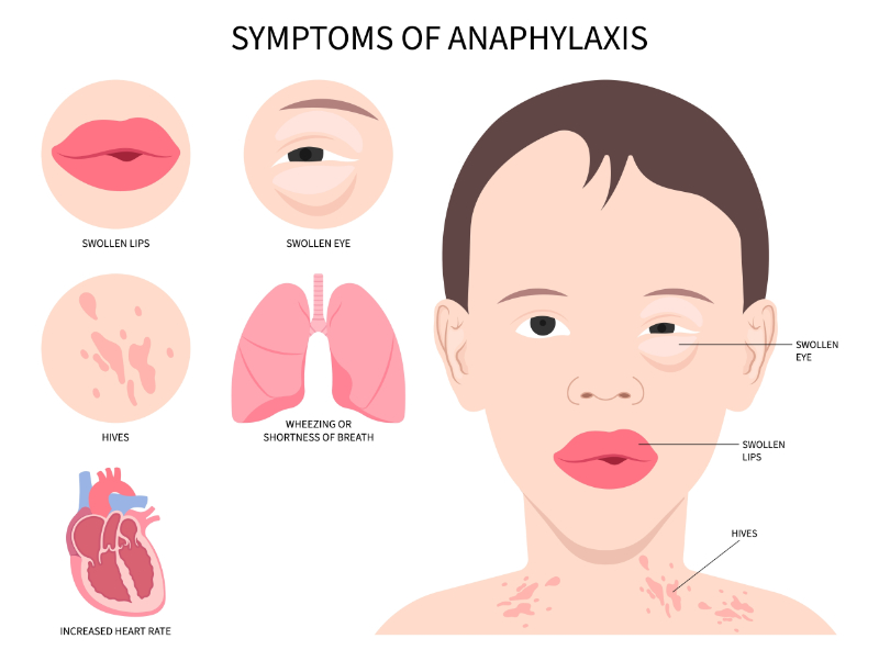 graphic showing symptoms of anaphylaxis