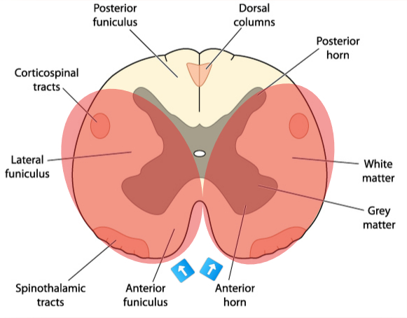 graphic showing location of lesion in ventral cord symdrome